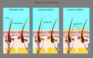 Врач-трихолог объясняет, как появляется перхоть и почему от нее важно избавиться