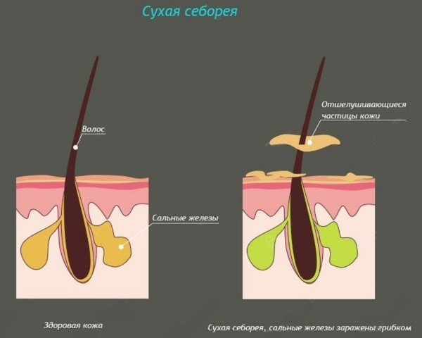 Маски от перхоти. Эффективные рецепты в домашних условиях: луковая, с касторовым, репейным, оливковым маслом, яйцом, медом, кефиром, лимоном